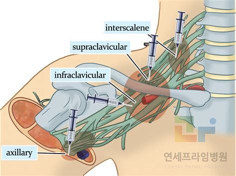 비중격코수술