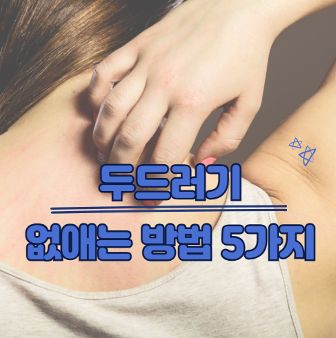 두드러기 가라앉히는법 5가지