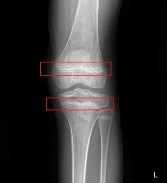성장판 닫혀도 키 클 수 있는 방법과 성장 호르몬 시기_6