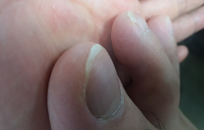 갈라지고있는-발톱