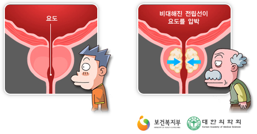 전립선비대증증상