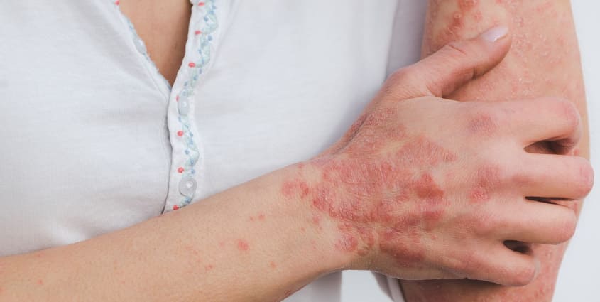 팔에 염증이 나 있다