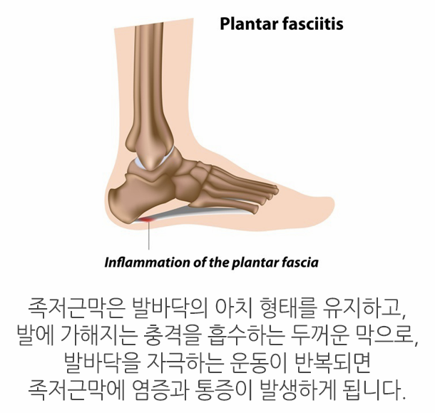 족저근막염 정의 설명 이미지
