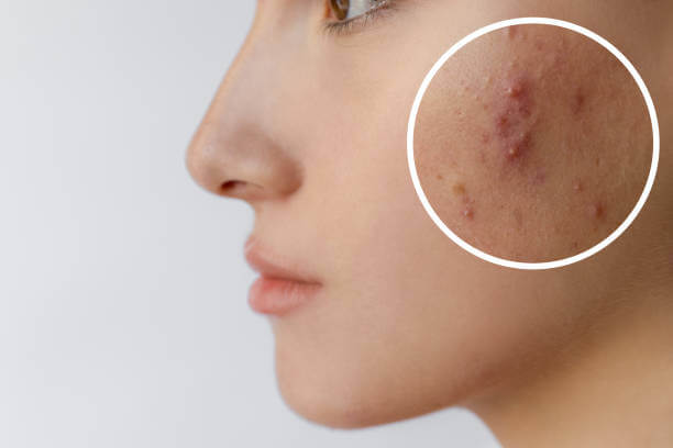 붉은 여드름 자국 없애는 법? 피부과 시술 전 꼭 알아야 할 팁