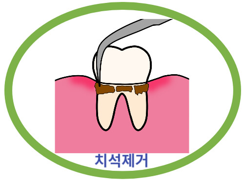 치석제거