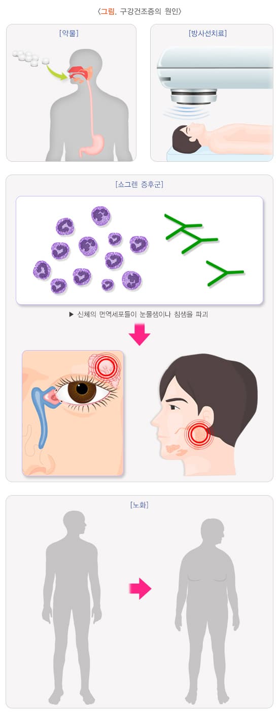 구강건조증, 입마름의 원인 및 치료 방법