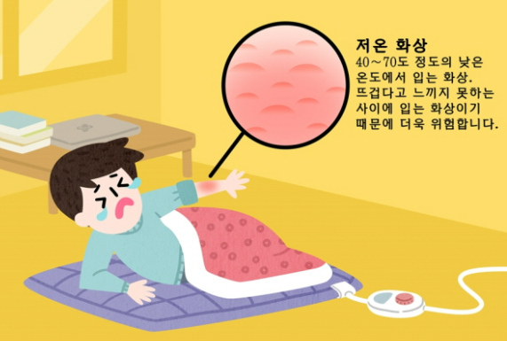 저온화상