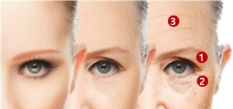 실리프팅 레이저리프팅