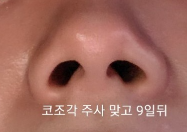 코조각주사 후기