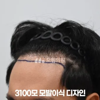 머리카락 이식 3000모 3000모낭 비용과 시술 과정_17