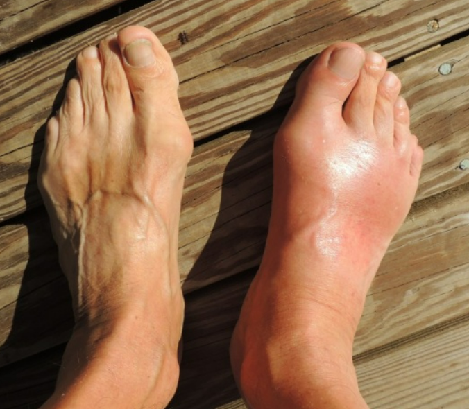 통풍 증상 - 부종