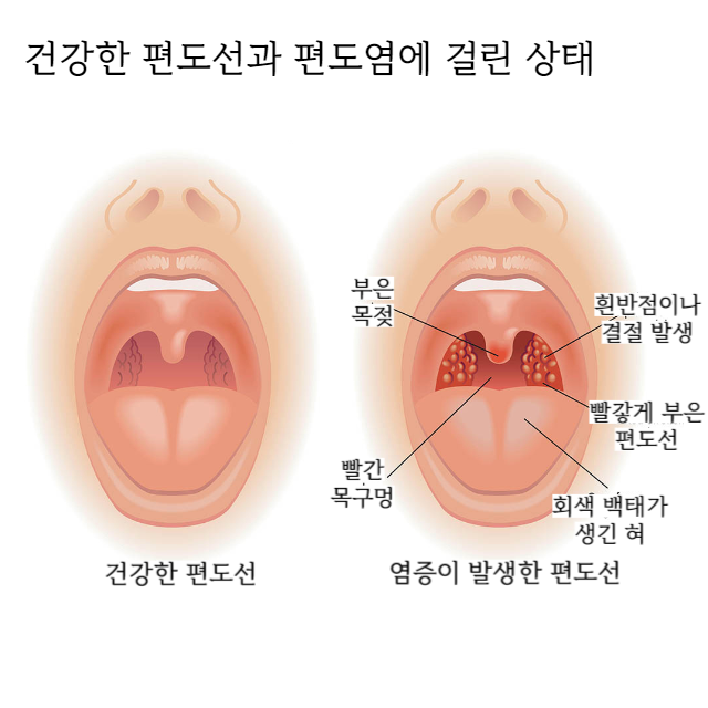 편도염
