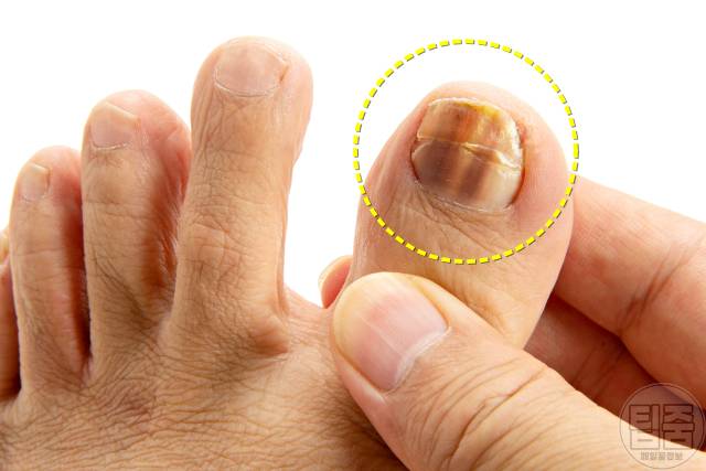 피부암 호발 부위 피부암자가진단 엄지발톱 손톱