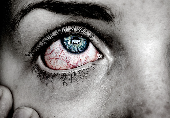 핏줄이 선 통증 눈 사진