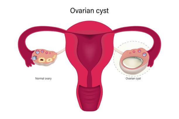 배란통 증상에는 여러가지 통증이 있는데 복부통증, 설사, 두통, 체온까지 변화합니다. 원인과 증상 완화할 수 있는 방법까지 알아봤습니다. 하지만 배란통이 너무 심하다면 병원 진료를 꼭 받아야겠지요? 참고하시기 바랍니다.