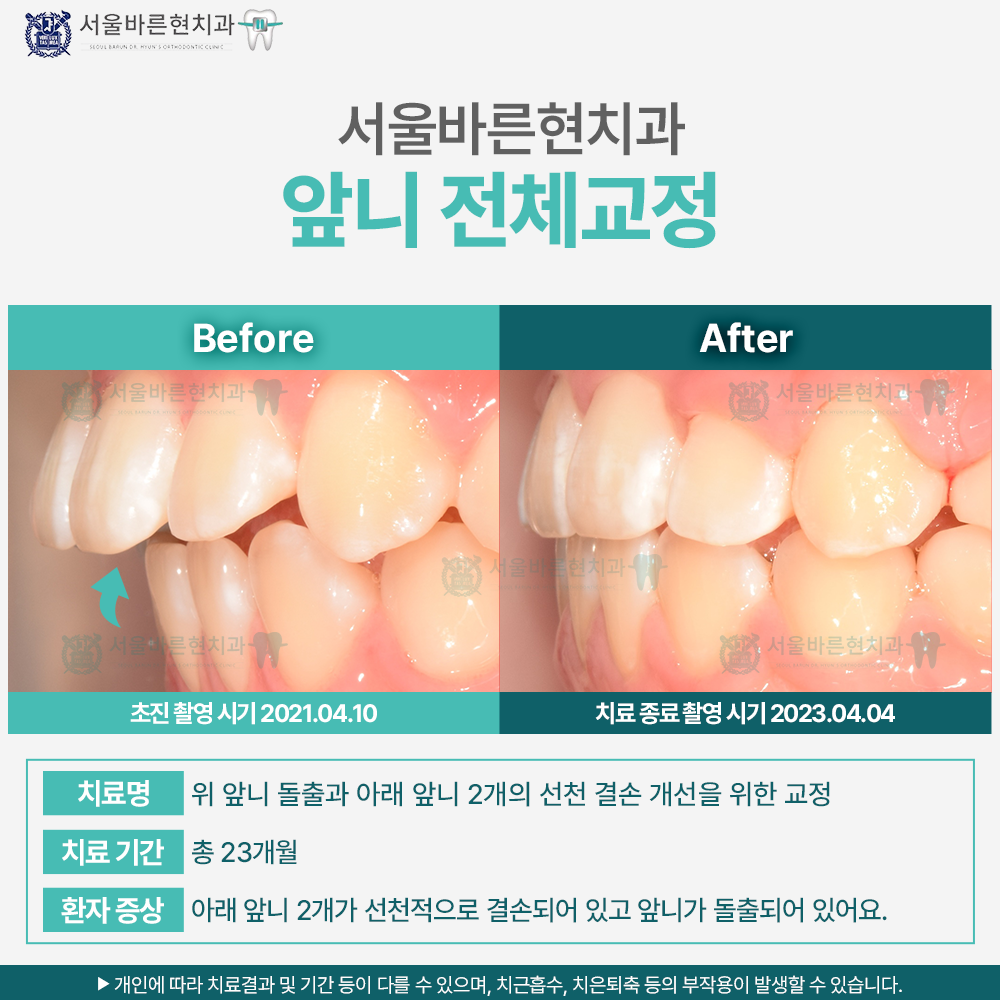 부산앞니교정