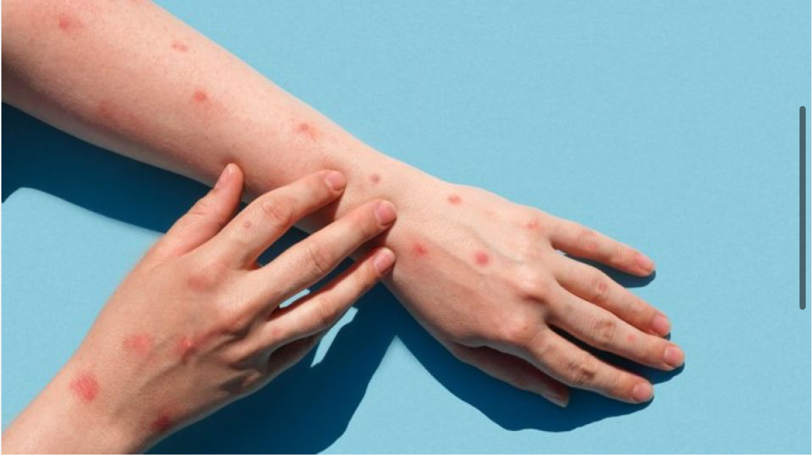 엠폭스-증상사진-감염경로