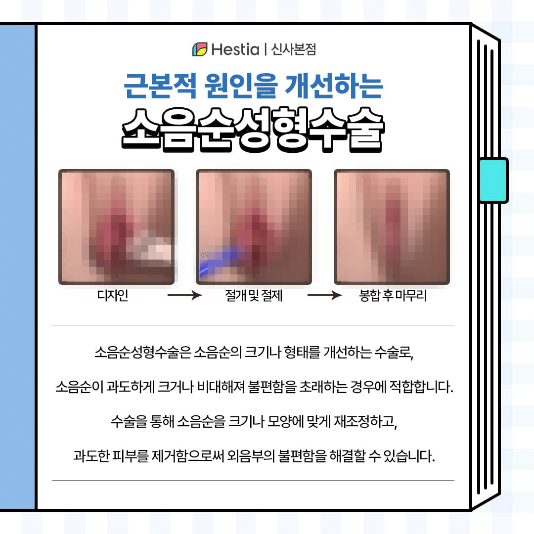 근본적인 해결책 : 소음순 성형수술이란?