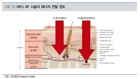 울쎄라 대체 가능한 HIFU 초음파 리프팅레이저 종류와 효과 가격비교