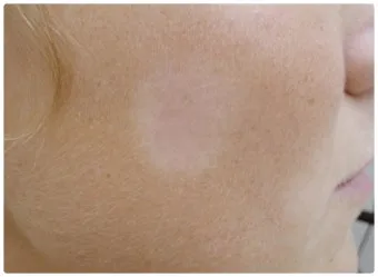 얼굴 버짐 증상 없애는 실전 방법 5가지 및 관리요령_5
