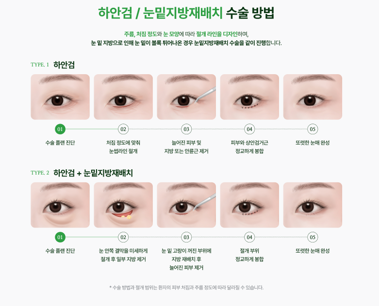 신사눈밑지방재배치 신사리프팅피부과