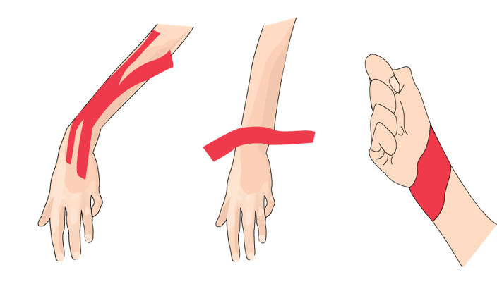 일반적인 손목 통증