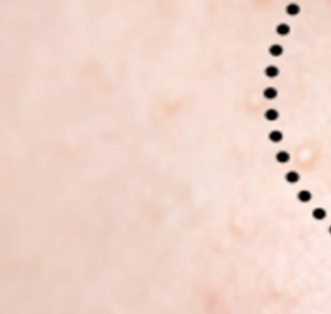 눈밑에 하얀 좁쌀