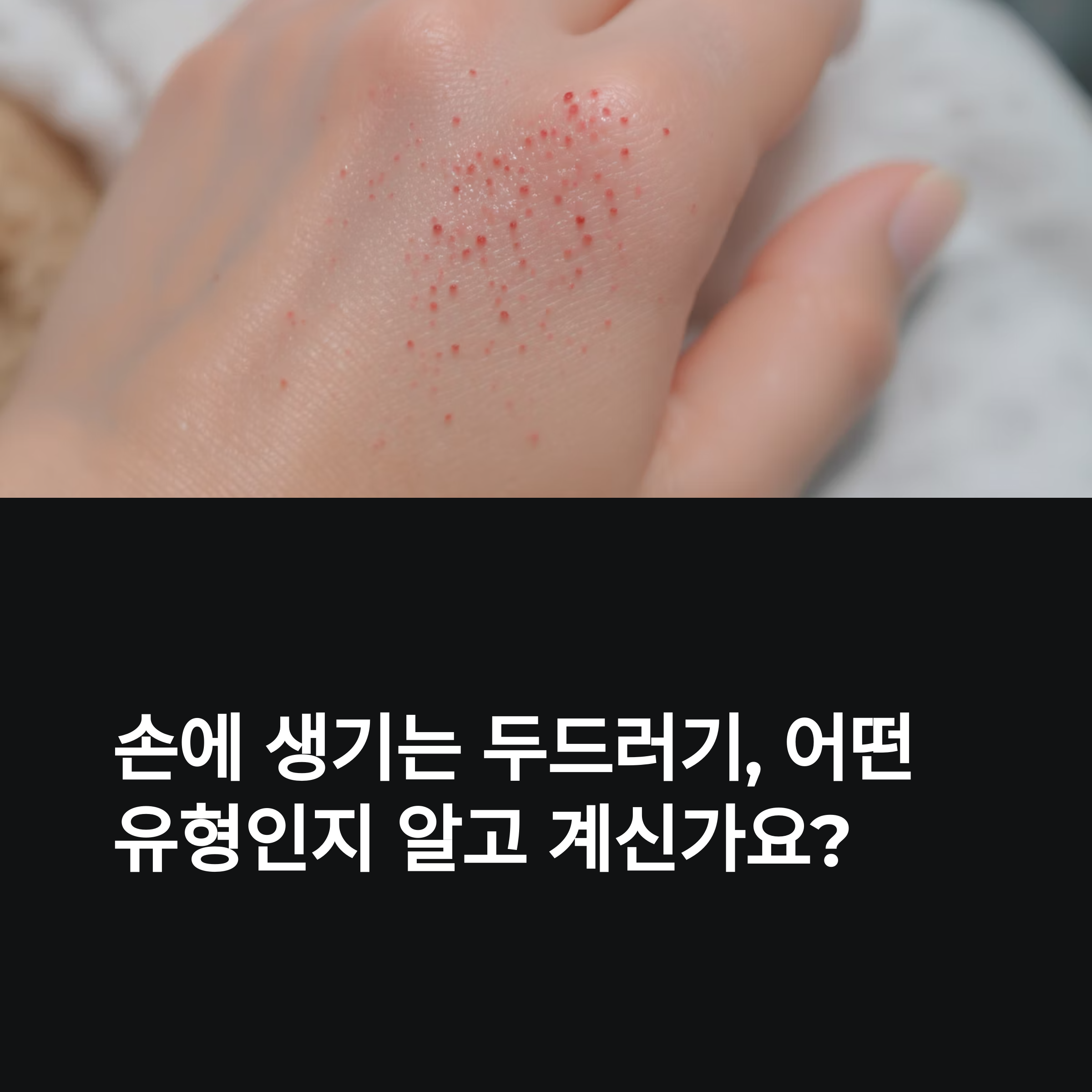 손에 생기는 두드러기 증상별 자가진단 가이드