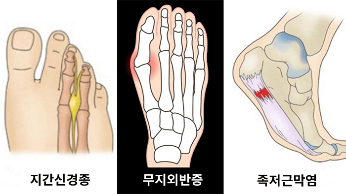발 관련 여러가지 질병
