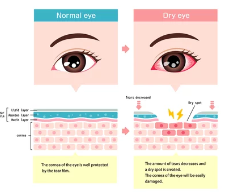 안구건조증/출처:어도비스톡