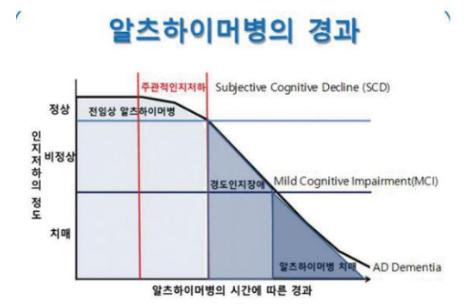 안과검사로 알츠하이머 조기 발견 가능성 관련 이미지