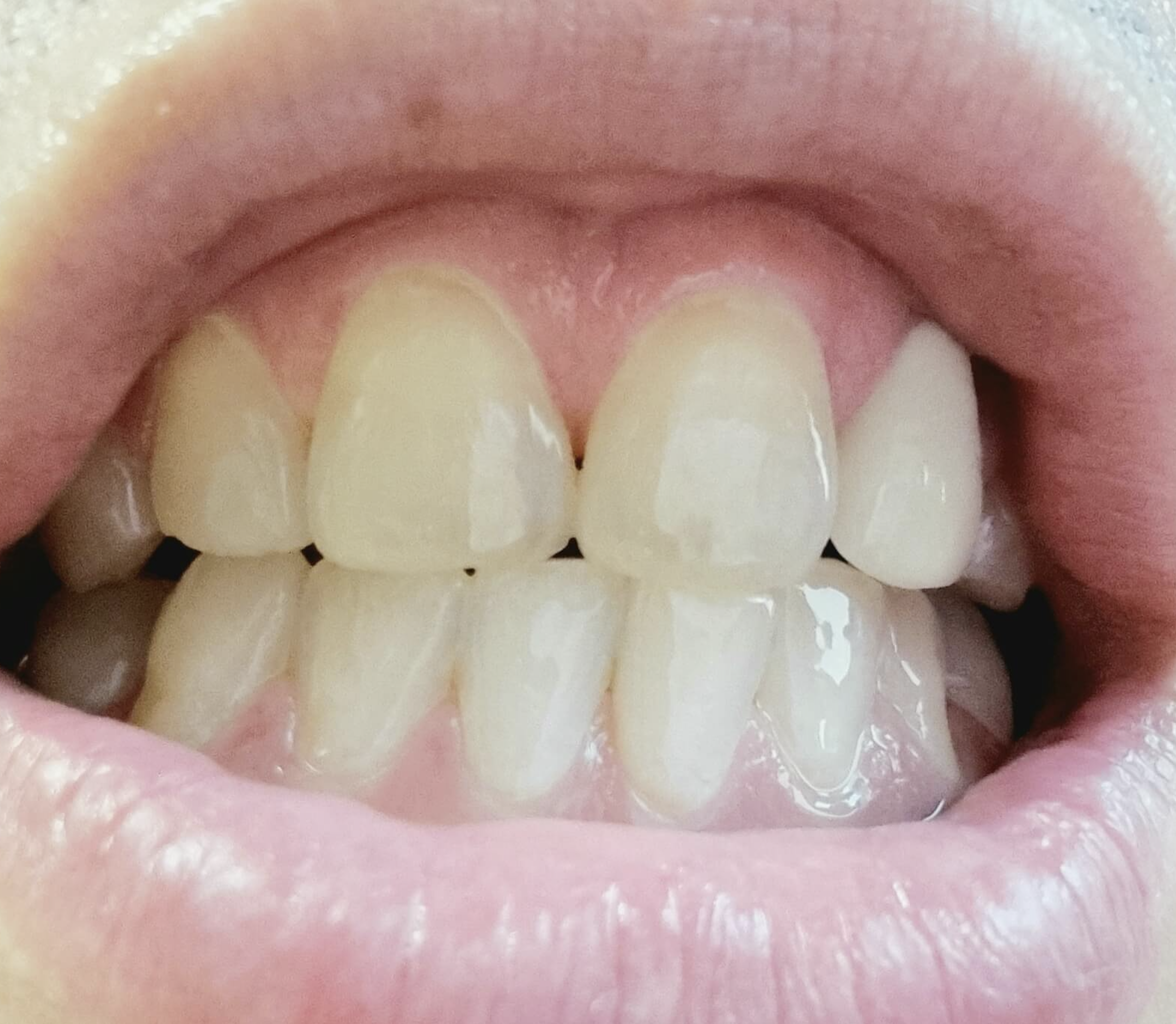 앞니-레진-교정