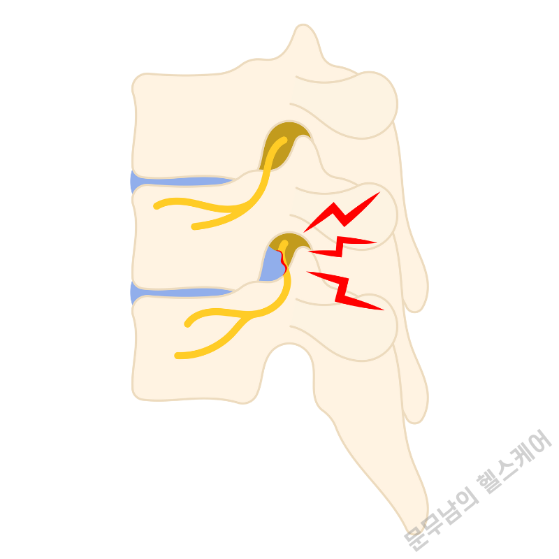 허리 디스크 다리 저림 증상