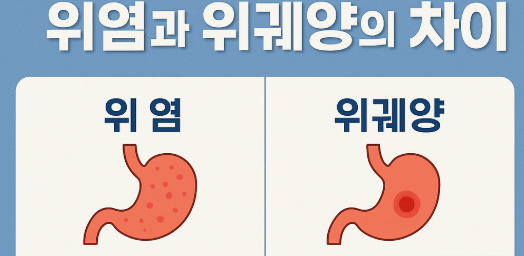 위염과 위궤양 증상 관련 사진