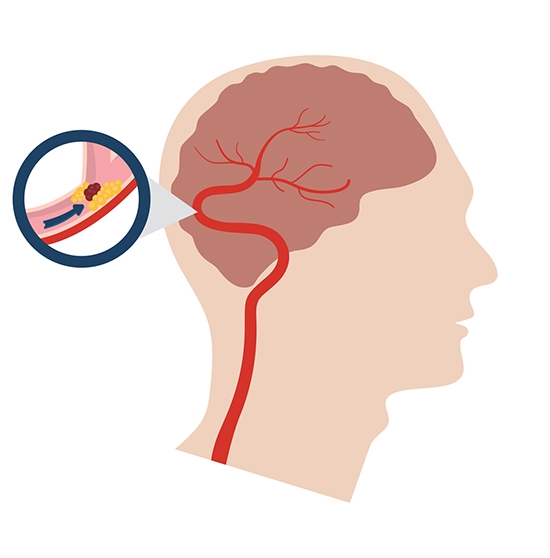 뇌졸중 전조 증상