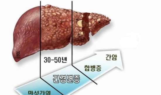 간 경변 관련 사진