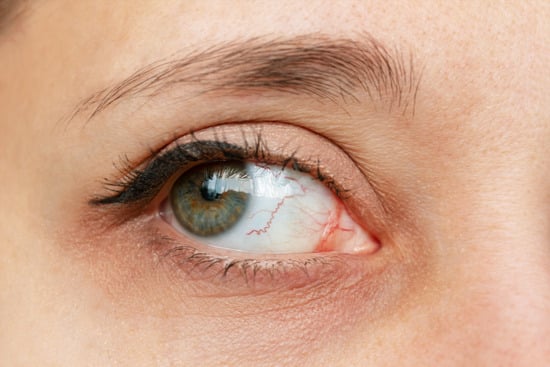 곰팡이성 각막염(Fungal Keratitis)
