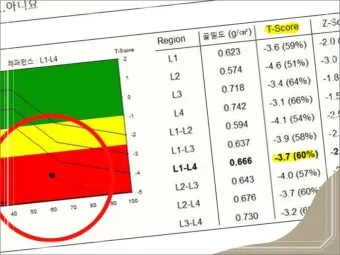 골밀도 검사 수치 골밀도 높이는 방법 간단 정리_9