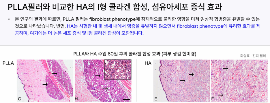힐로웨이브 팔자주름 필러 원리 효과 정리