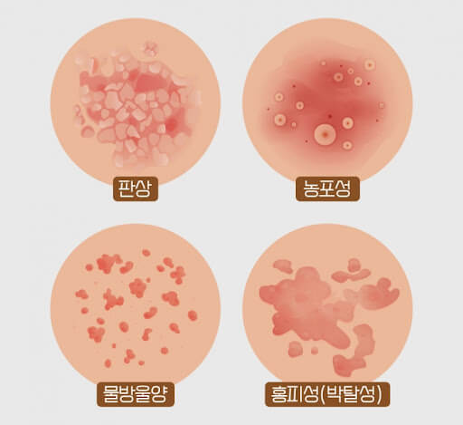 건선 증상과 자가치료