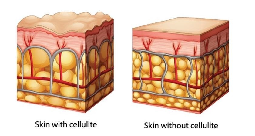 섬유화된 격막이 지방을 잡아당겨 울퉁불퉁해진 피부 표면과 림프 정체