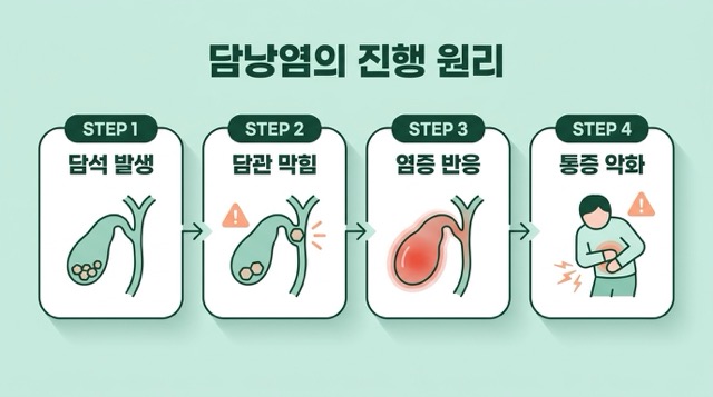 담낭염 원리 담낭 염증 담즙 정체 통증 악화