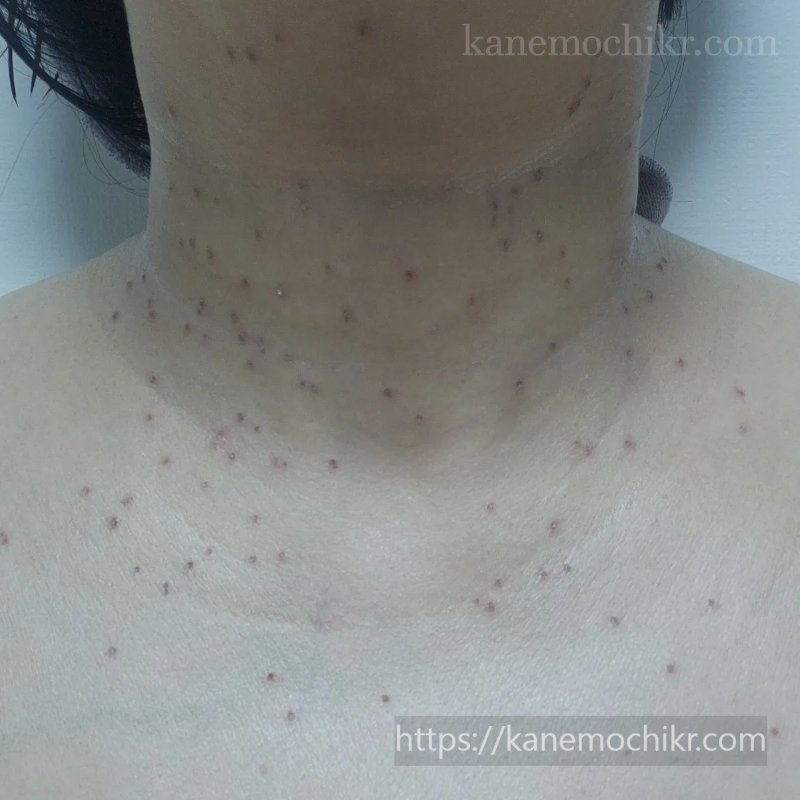 쥐젖-편평사마귀-제거-2일차