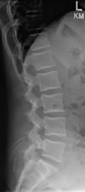 정상 요추 xray