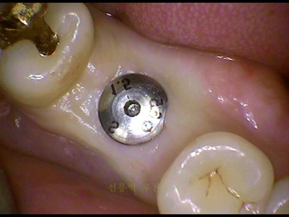 무절개 임플란트