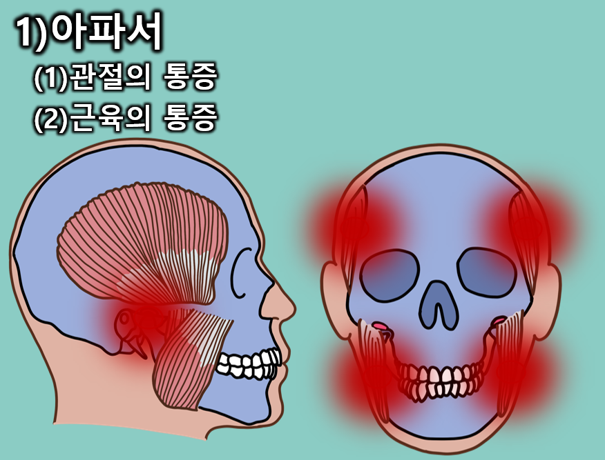 개구장애, 입이 안벌어지는 턱관절 장애 원인과 그 모든 것