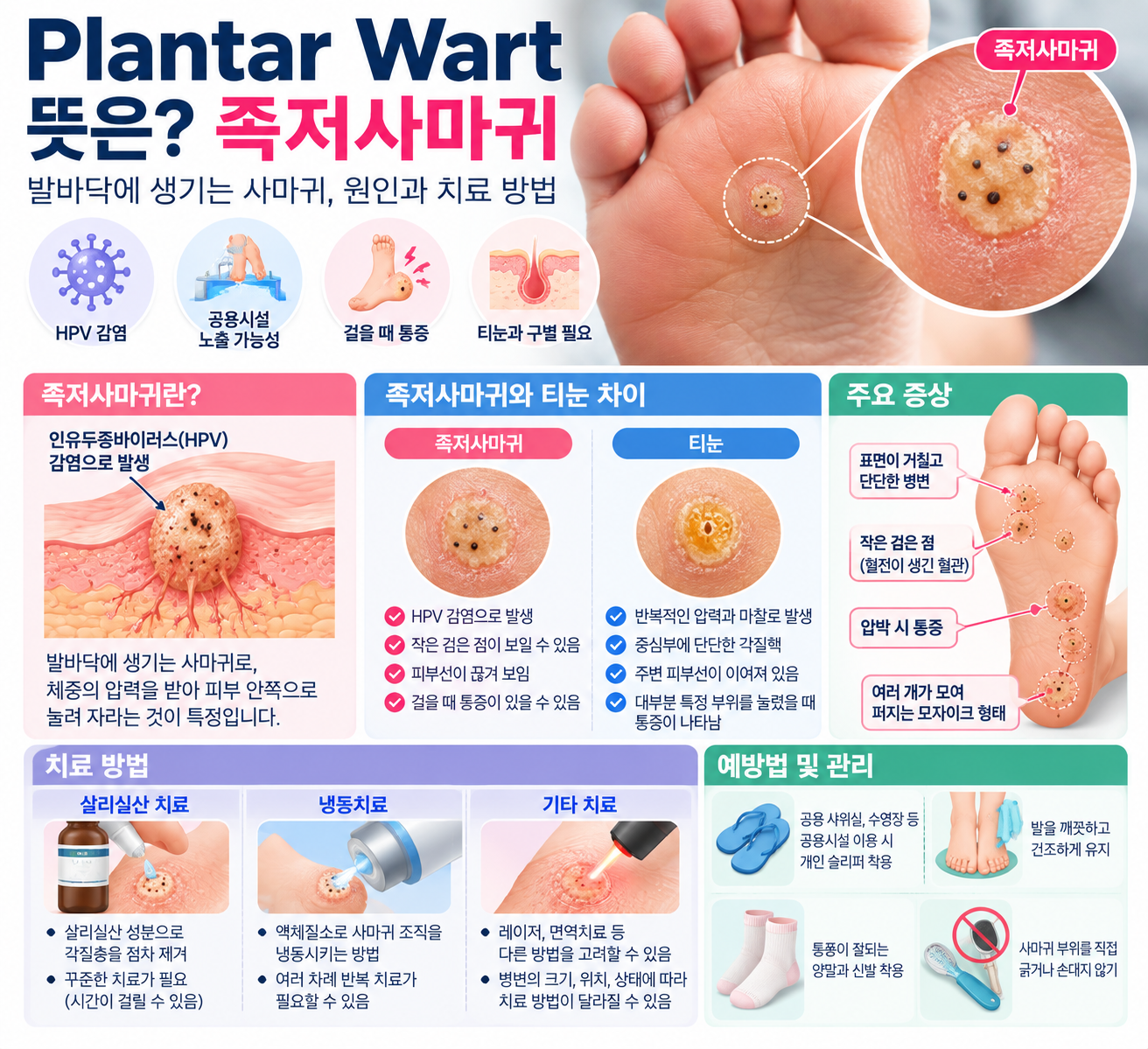 Plantar Wart 뜻은? 족저사마귀 원인과 티눈 차이&middot;치료 방법