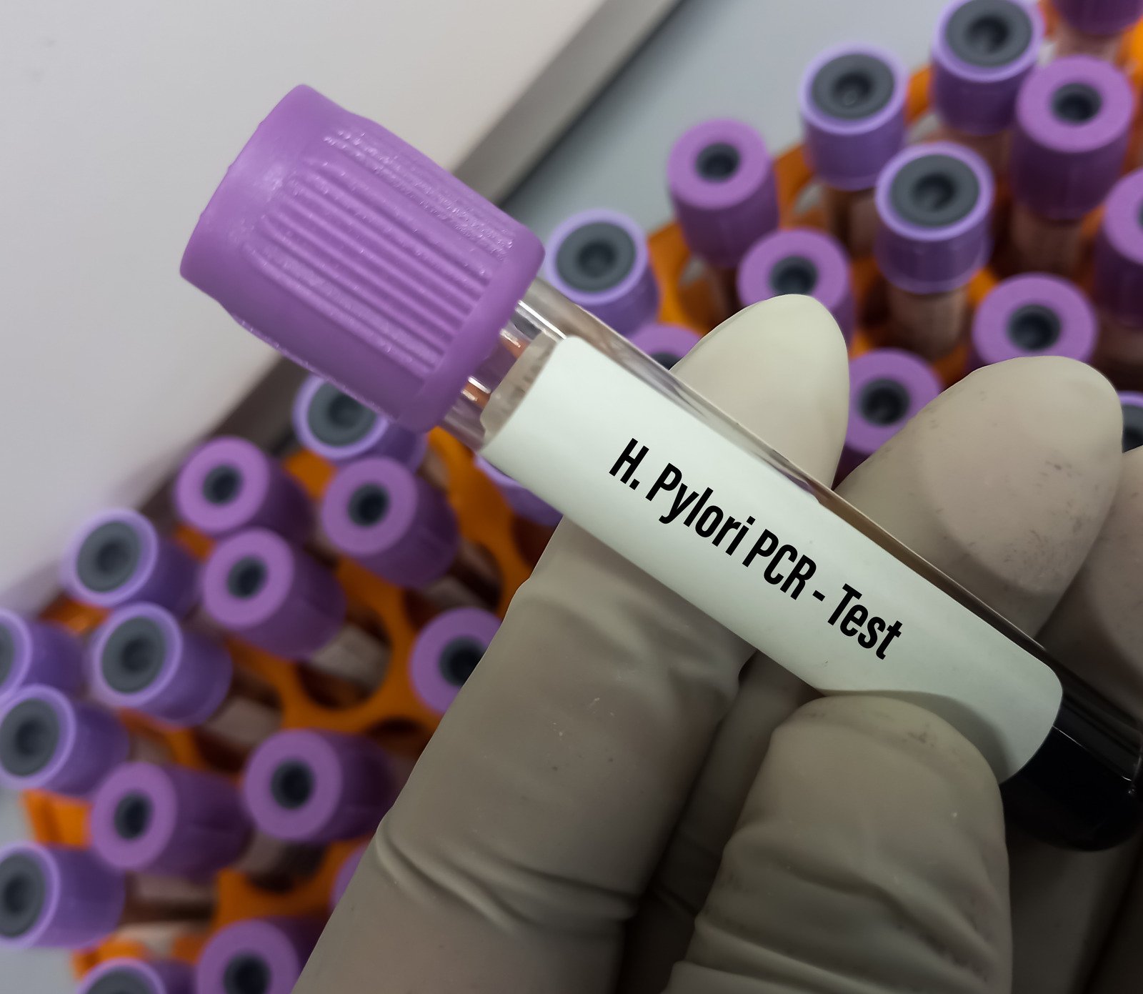 헬리코박터 파일로리(H. pylori) 감염: 원인, 증상, 치료 및 예방