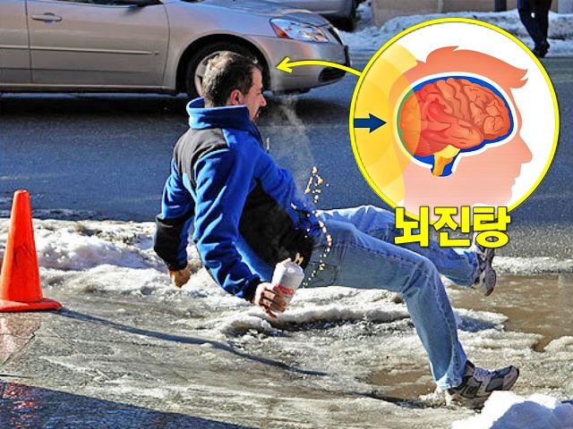 뇌진탕 초기증상, 뇌진탕 증상, 건강 팁줌 매일꿀정보