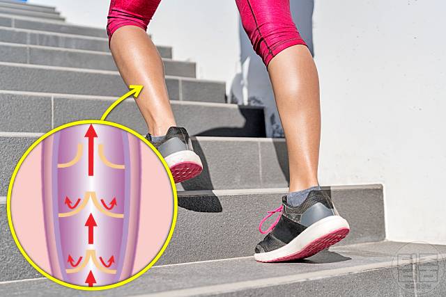 종아리 혈관 튀어나옴 하지정맥류 증상 예방 계단